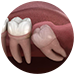 wisdom tooth removal BTM Layout 1st Stage